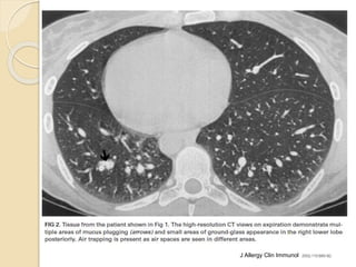 J Allergy Clin Immunol 2002;110:685-92.
 