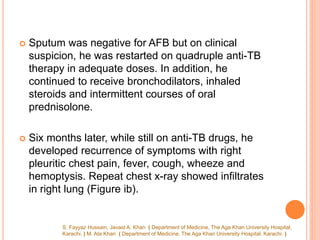  Sputum was negative for AFB but on clinical
suspicion, he was restarted on quadruple anti-TB
therapy in adequate doses. In addition, he
continued to receive bronchodilators, inhaled
steroids and intermittent courses of oral
prednisolone.
 Six months later, while still on anti-TB drugs, he
developed recurrence of symptoms with right
pleuritic chest pain, fever, cough, wheeze and
hemoptysis. Repeat chest x-ray showed infiltrates
in right lung (Figure ib).
S. Fayyaz Hussain, Javaid A. Khan ( Department of Medicine, The Aga Khan University Hospital,
Karachi. ) M. Ata Khan ( Department of Medicine, The Aga Khan University Hospital. Karachi. )
 