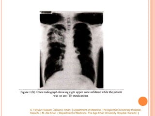 S. Fayyaz Hussain, Javaid A. Khan ( Department of Medicine, The Aga Khan University Hospital,
Karachi. ) M. Ata Khan ( Department of Medicine, The Aga Khan University Hospital. Karachi. )
 