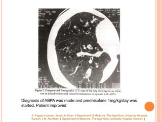 S. Fayyaz Hussain, Javaid A. Khan ( Department of Medicine, The Aga Khan University Hospital,
Karachi. ) M. Ata Khan ( Department of Medicine, The Aga Khan University Hospital. Karachi. )
Diagnosis of ABPA was made and prednisolone 1mg/kg/day was
started. Patient improved
 