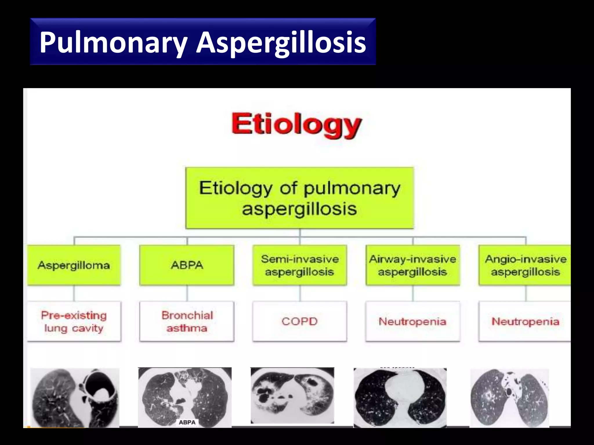 Allergic Broncho Pulmonary Aspergillosis (ABPA) by Dr.Tinku Joseph | PPTX