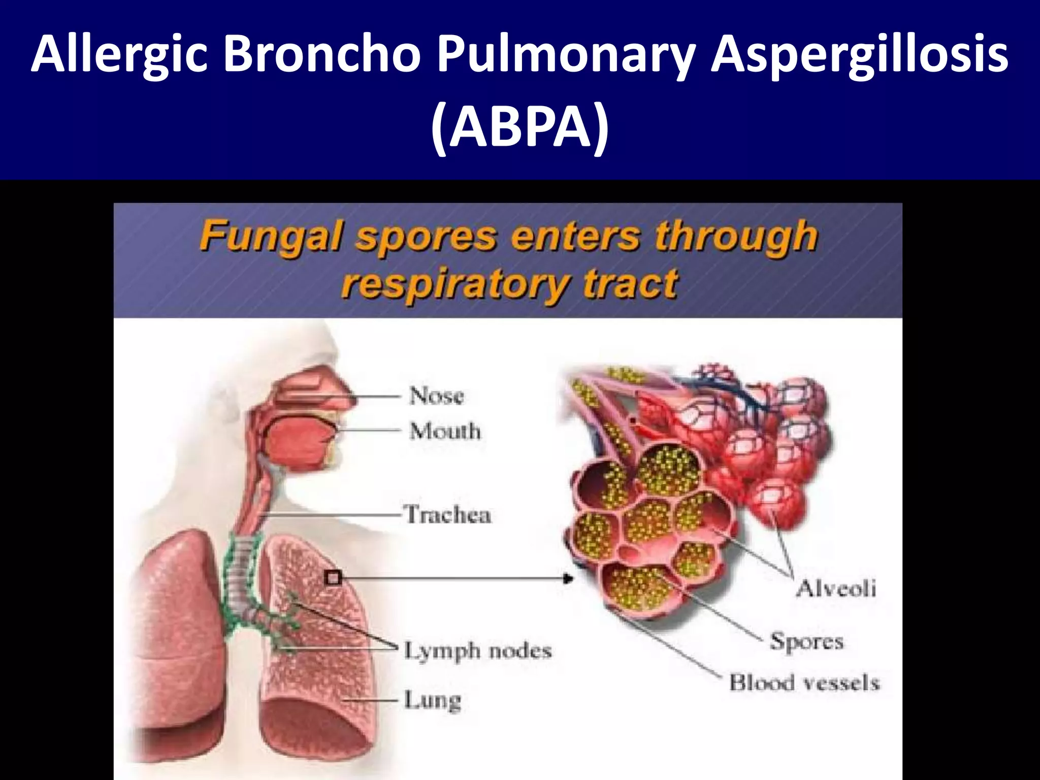 Allergic Broncho Pulmonary Aspergillosis (ABPA) by Dr.Tinku Joseph | PPTX