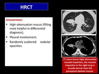 Allergic Broncho Pulmonary Aspergillosis (ABPA) by Dr.Tinku Joseph | PPTX