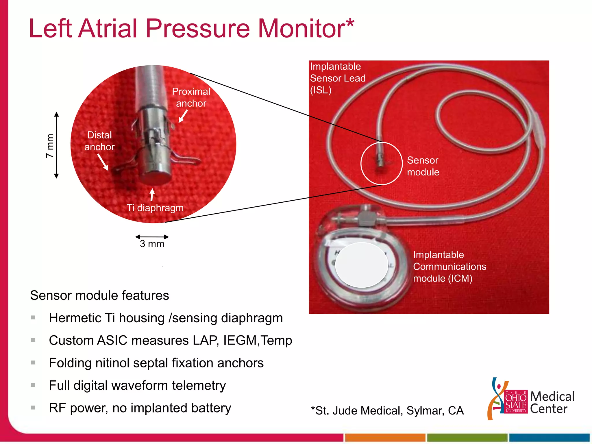 Proximal anchor7 mmDistal anchorTi diaphragm 3 mmLeft Atrial Pressure Monitor*Implantable Sensor Lead(ISL)Sensor moduleImplantable Communications module (ICM)Sensor module featuresHermetic Ti housing /sensing diaphragmCustom ASIC measures LAP, IEGM,TempFolding nitinol septal fixation anchorsFull digital waveform telemetryRF power, no implanted battery*St. Jude Medical, Sylmar, CA