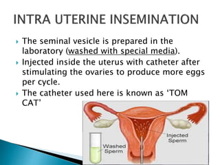  The seminal vesicle is prepared in the
laboratory (washed with special media).
 Injected inside the uterus with catheter after
stimulating the ovaries to produce more eggs
per cycle.
 The catheter used here is known as ‘TOM
CAT’
 