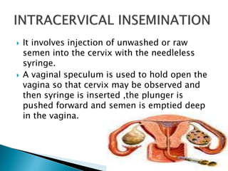  It involves injection of unwashed or raw
semen into the cervix with the needleless
syringe.
 A vaginal speculum is used to hold open the
vagina so that cervix may be observed and
then syringe is inserted ,the plunger is
pushed forward and semen is emptied deep
in the vagina.
 