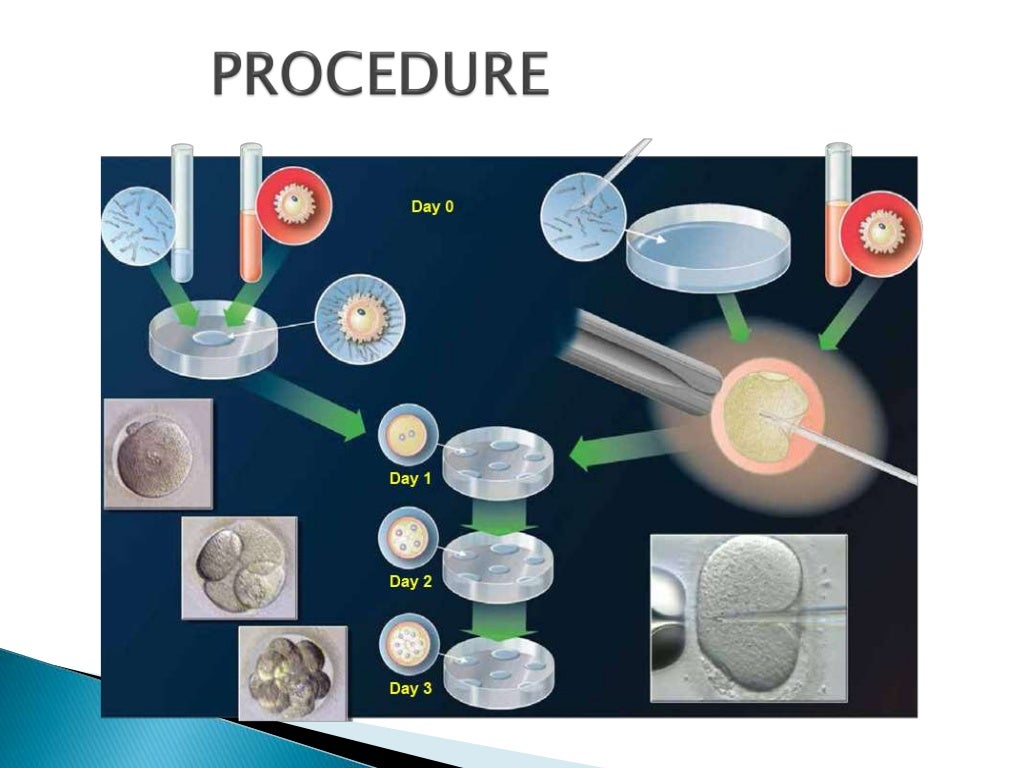 Artificial Reproductive Technology