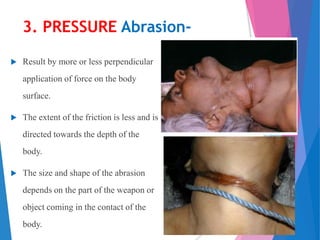 Abrasion | PPTX