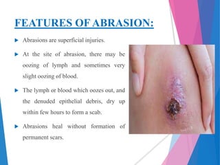 Abrasion | PPTX