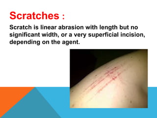 Scratches :
Scratch is linear abrasion with length but no
significant width, or a very superficial incision,
depending on the agent.
 