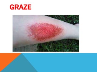 GRAZE
 
