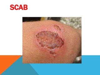 SCAB
 