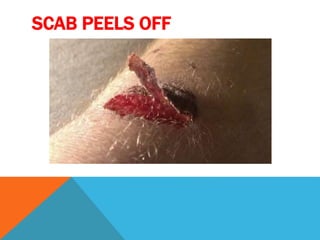 SCAB PEELS OFF
 