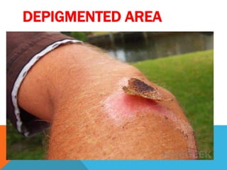 DEPIGMENTED AREA
 