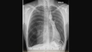 A breathless patient