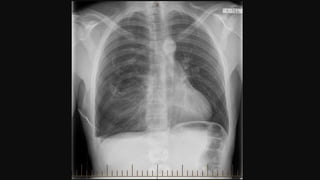 A breathless patient