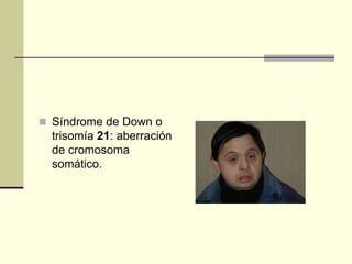  Síndrome de Down o
trisomía 21: aberración
de cromosoma
somático.
 