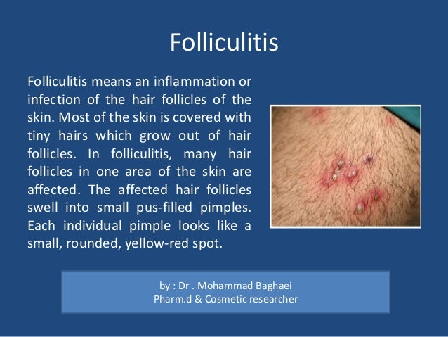 A Brief Review Skin Cysts Lumps And Bumps