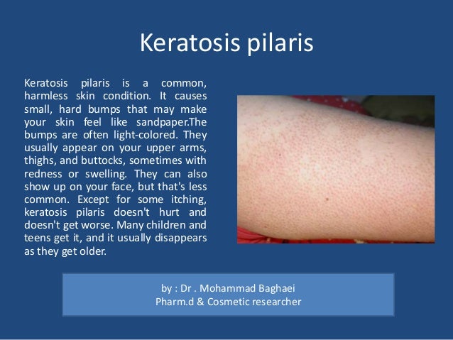 A Brief Review Skin Cysts Lumps And Bumps