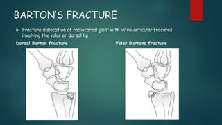 A brief review of distal radius fractures | PPTX