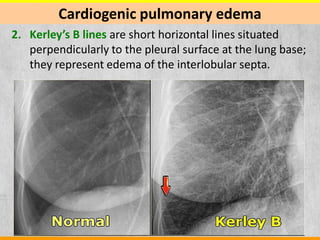 A brief synopsis of acute decompensated heart failure | PDF