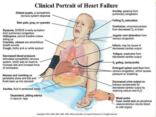 A brief synopsis of acute heart failure