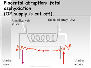 Umbilical artery (UA)Umbilical vein
(UV)
Uterine
arteries
Uterine
veins
Abruption
Archer TL 2006 unpublished
Placental abruption: fetal
asphyxiation
(O2 supply is cut off).
 