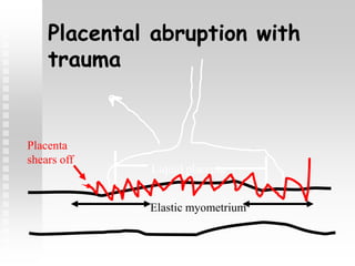 Placental abruption with
trauma
Elastic myometrium
Liquid placenta
Placenta
shears off
 