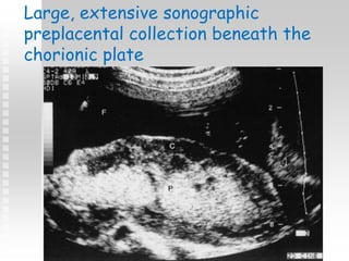 Large, extensive sonographic
preplacental collection beneath the
chorionic plate
 