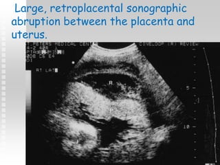 Large, retroplacental sonographic
abruption between the placenta and
uterus.
 