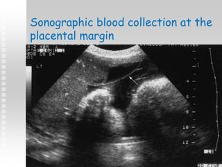 Sonographic blood collection at the
placental margin
 