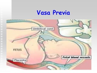 Vasa Previa
 