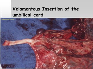 Velamentous Insertion of the
umbilical cord
 
