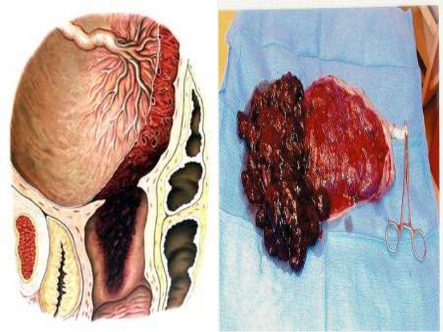 Abruptio placenta Abruptio placenta