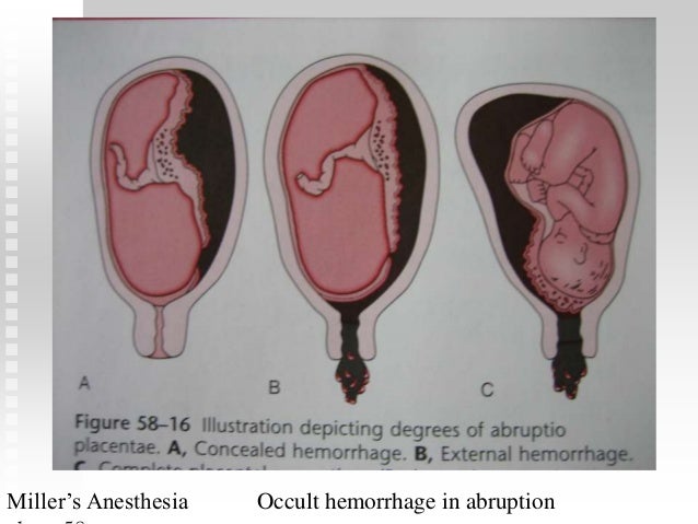 abruptio placenta abruptio placentae