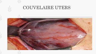 COUVELAIRE UTERS
 