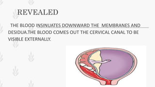 REVEALED
THE BLOOD INSINUATES DOWNWARD THE MEMBRANES AND
DESIDUA.THE BLOOD COMES OUT THE CERVICAL CANAL TO BE
VISIBLE EXTERNALLY.
 