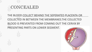 CONCEALED
THE BLOOD COLLECT BEHIND THE SEPERATED PLACENTA OR
COLLECTED IN BETWEEN THE MEMBRANES.THE COLLECTED
BLOOD IS PREVENTED FROM COMING OUT THE CERVIX BY
PRESENTING PARTS ON LOWER SEGMENT.
 