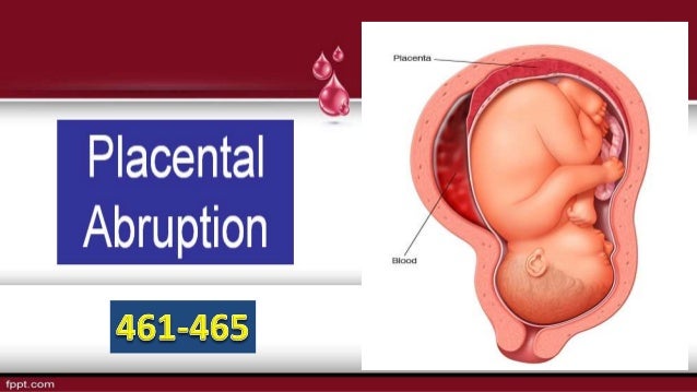 Placental Abruption (Accidental hemorrhage) Placental Abruption (Accidental hemorrhage)