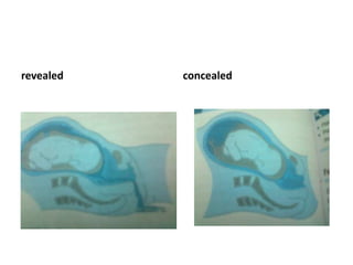 revealed concealed
 