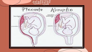 abruptio placenta , ante partum hemorrhage
