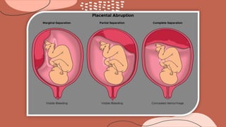abruptio placenta , ante partum hemorrhage