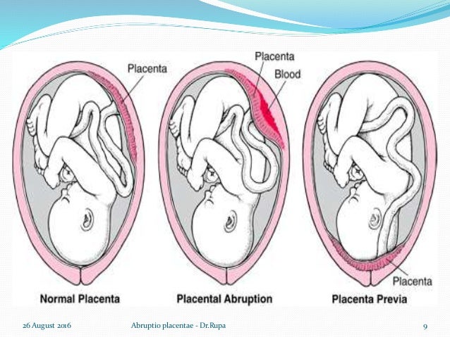 abruptio placentae abruptio placentae