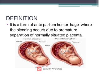 DEFINITION
• It is a form of ante partum hemorrhage where
the bleeding occurs due to premature
separation of normally situated placenta.
 