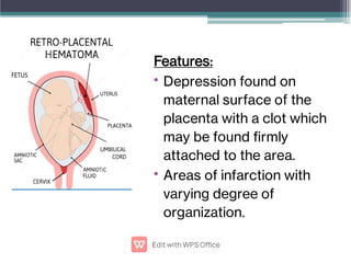 •
•
Features:
Depression found on
maternal surface of the
placenta with a clot which
may be found rmly
attached to the area.
Areas of infarction with
varying degree of
organization.
 