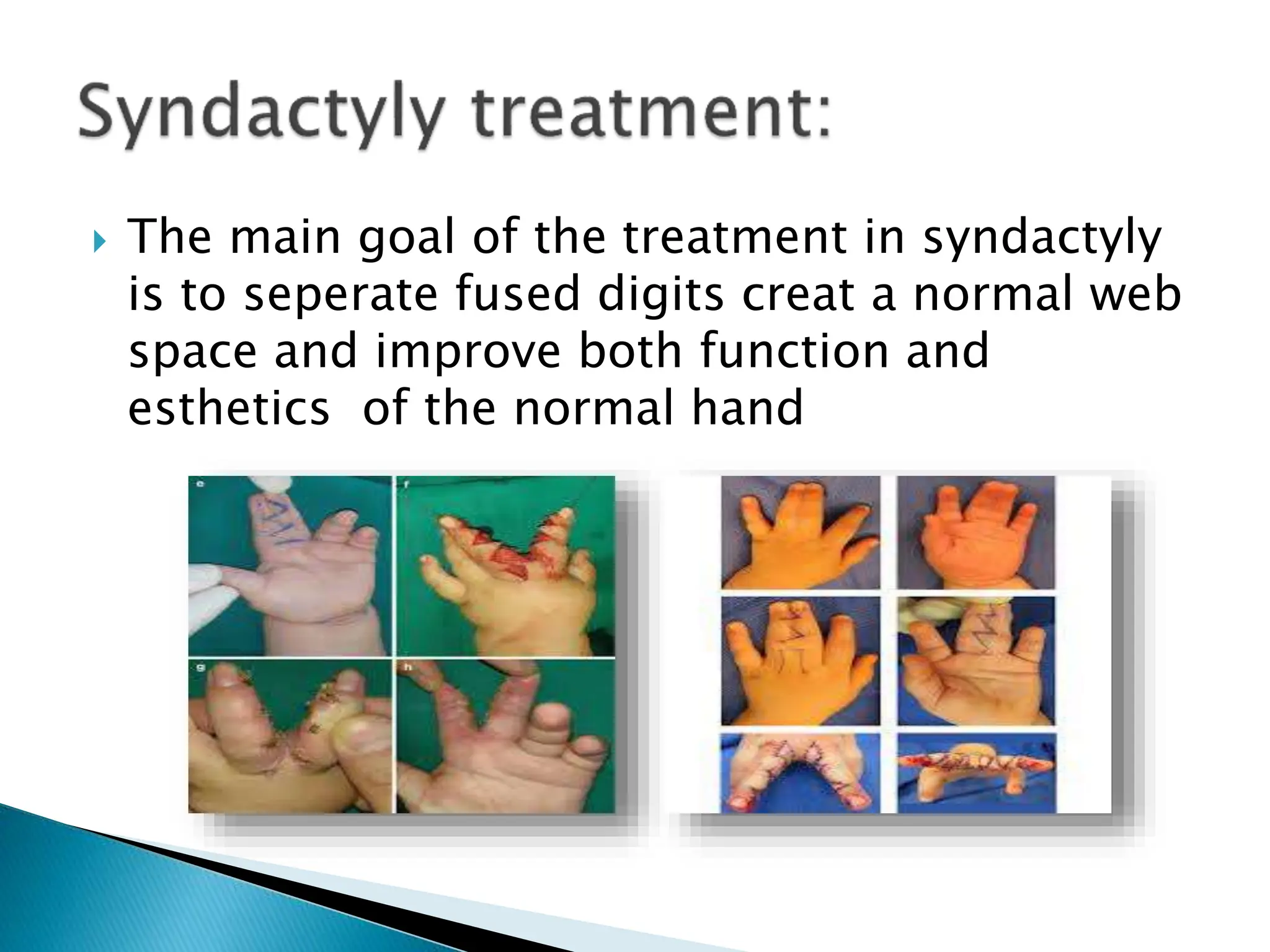 ABS AMNIOTIC BAND SYNDROM ORTHOPEDIE pptx