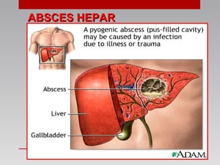 ABSCES HEPARABSCES HEPAR
 