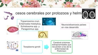 Abscesos cerebrales por protozoos y helmintos
Trypanosoma cruzi,
Entamoeba histolytica,
Schistosoma spp. y
Paragonimus spp.
Neurocisticercosis países
en vías desarrollo
Toxoplasma gondii
Cerebral síntomas
extrapiramidales que
recuerdan a los de la
enfermedad de
Parkinson
 
