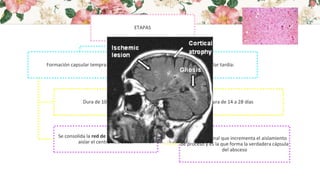 ETAPAS
Formación capsular temprana:
Dura de 10 a 13 días.
Se consolida la red de colágeno con vistas a
aislar el centro necrótico.
Formación capsular tardía:
Dura de 14 a 28 días
Gliosis reaccional que incrementa el aislamiento
de proceso y es la que forma la verdadera cápsula
del absceso
 