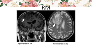 RM
hipointensa en T1 hiperintensa en T2
 